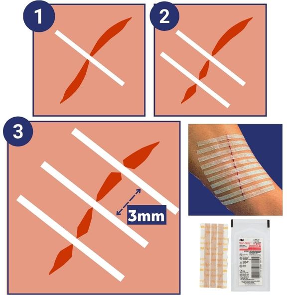 steristrip​
