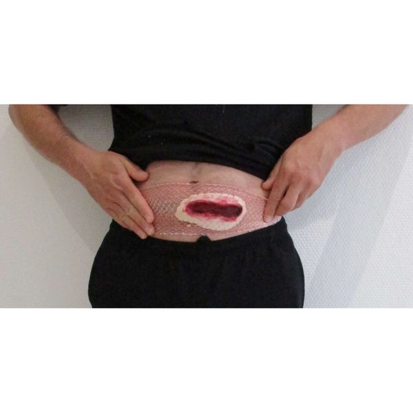 Plaie filet - Blessure abdominale